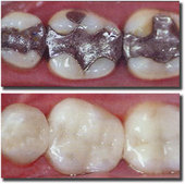 veneers procedure before and after